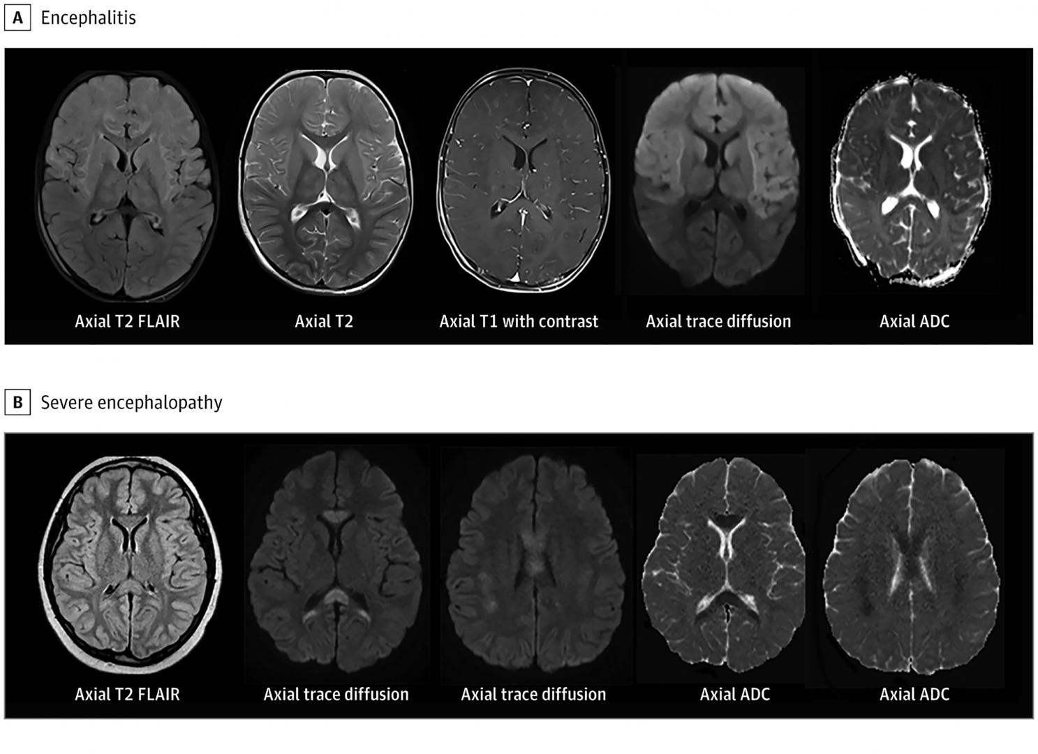 DAÑO. Tomografías de un niño que estaba sano antes de contraer el síndrome inflamatorio multisistémico (arriba) y las de un niño en edad escolar con la condición (abajo). 