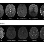 DAÑO. Tomografías de un niño que estaba sano antes de contraer el síndrome inflamatorio multisistémico (arriba) y las de un niño en edad escolar con la condición (abajo). 