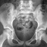 CRÍTICO. Radiografía de una niña sana de 10 años. Los especialistas explican que la pelvis de un niña es demasiado pequeña para permitir el paso de un feto.