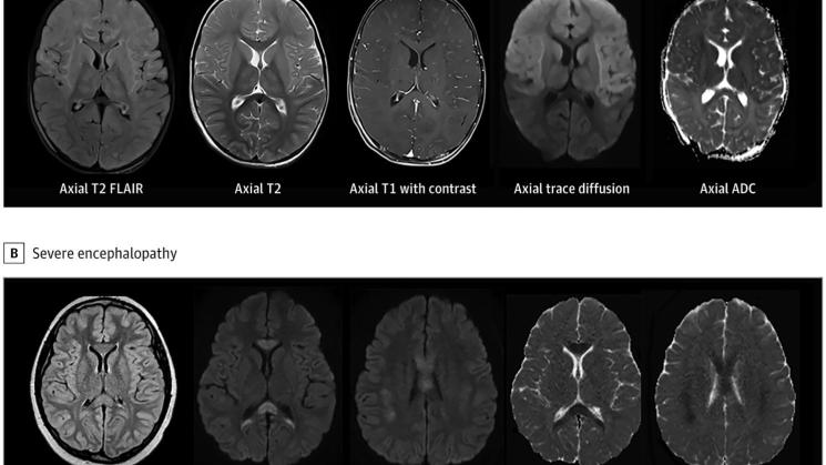 DAÑO. Tomografías de un niño que estaba sano antes de contraer el síndrome inflamatorio multisistémico (arriba) y las de un niño en edad escolar con la condición (abajo). 
