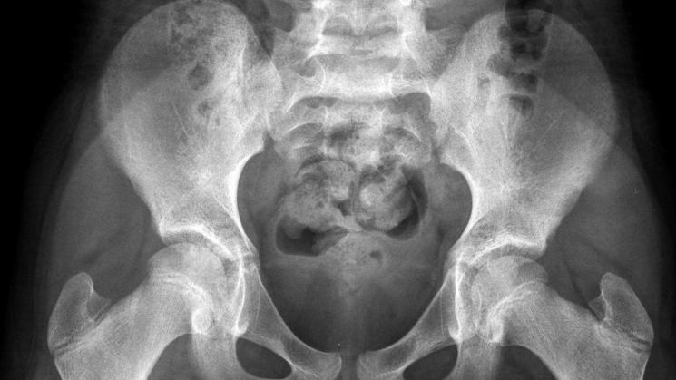 CRÍTICO. Radiografía de una niña sana de 10 años. Los especialistas explican que la pelvis de un niña es demasiado pequeña para permitir el paso de un feto.