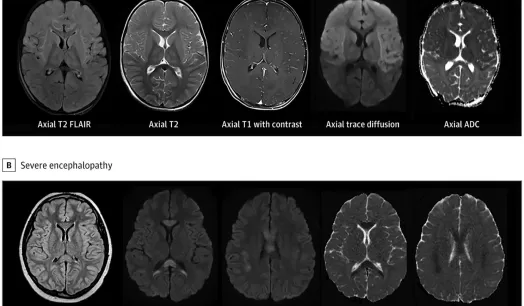 DAÑO. Tomografías de un niño que estaba sano antes de contraer el síndrome inflamatorio multisistémico (arriba) y las de un niño en edad escolar con la condición (abajo). 